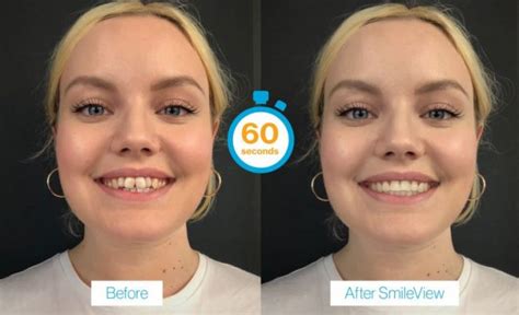 dentist penge|bupa dental invisalign.